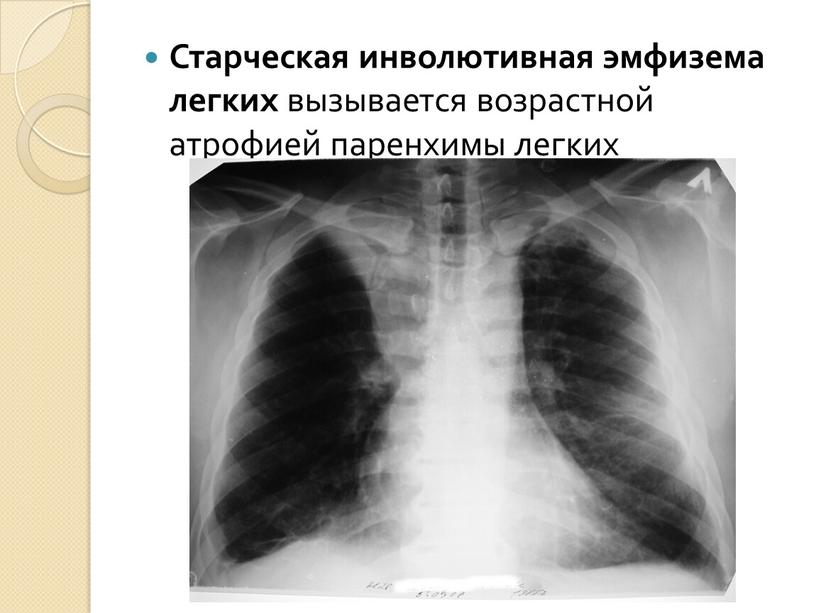 Старческая инволютивная эмфизема легких вызывается возрастной атрофией паренхимы легких