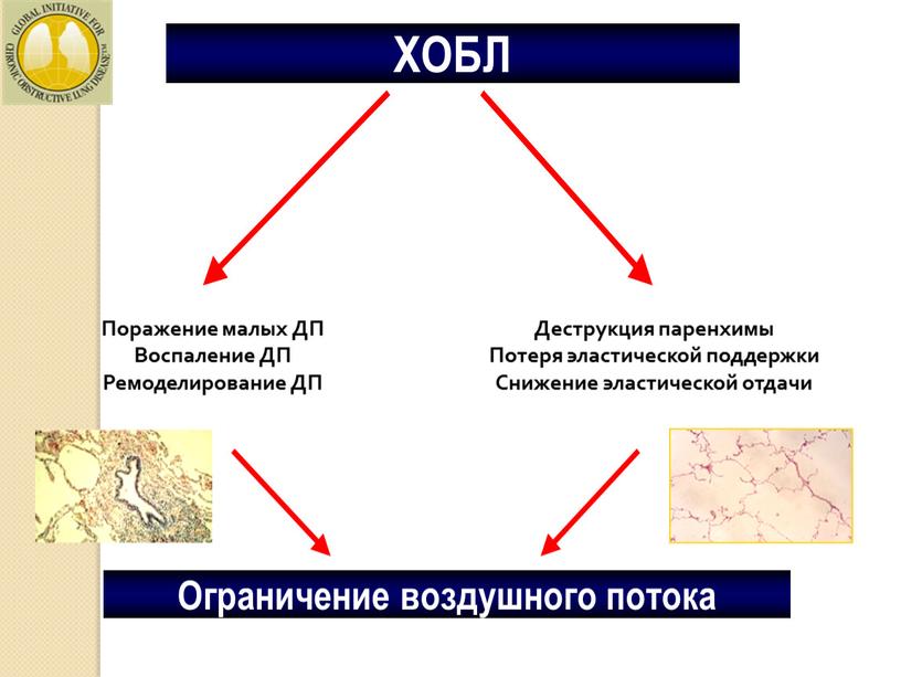 ХОБЛ Поражение малых ДП Воспаление