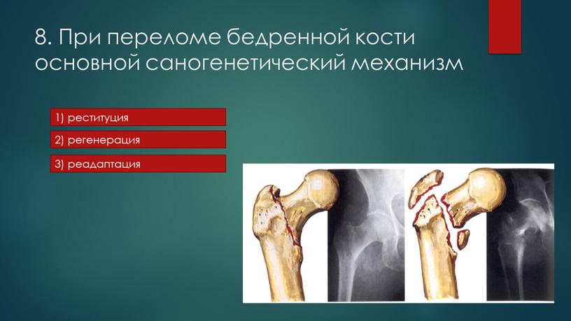 При переломе бедренной кости основной саногенетический механизм 1) реституция 2) регенерация 3) реадаптация