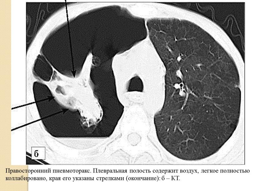 Правосторонний пневмоторакс. Плевральная полость содержит воздух, легкое полностью коллабировано, края его указаны стрелками (окончание): б –