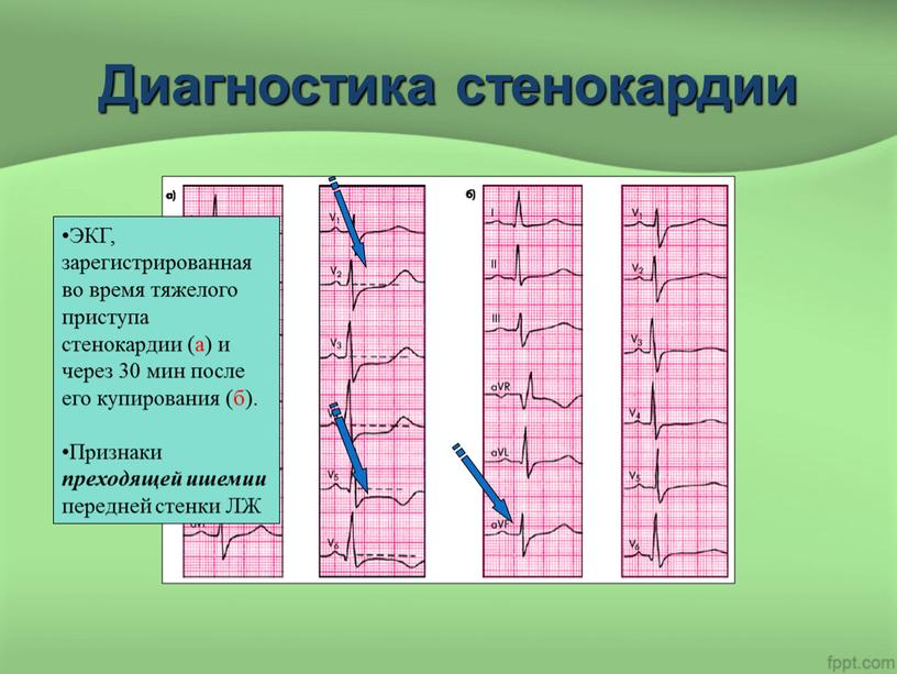 Диагностика стенокардии ЭКГ, зарегистрированная во время тяжелого приступа стенокардии (а) и через 30 мин после его купирования (б)