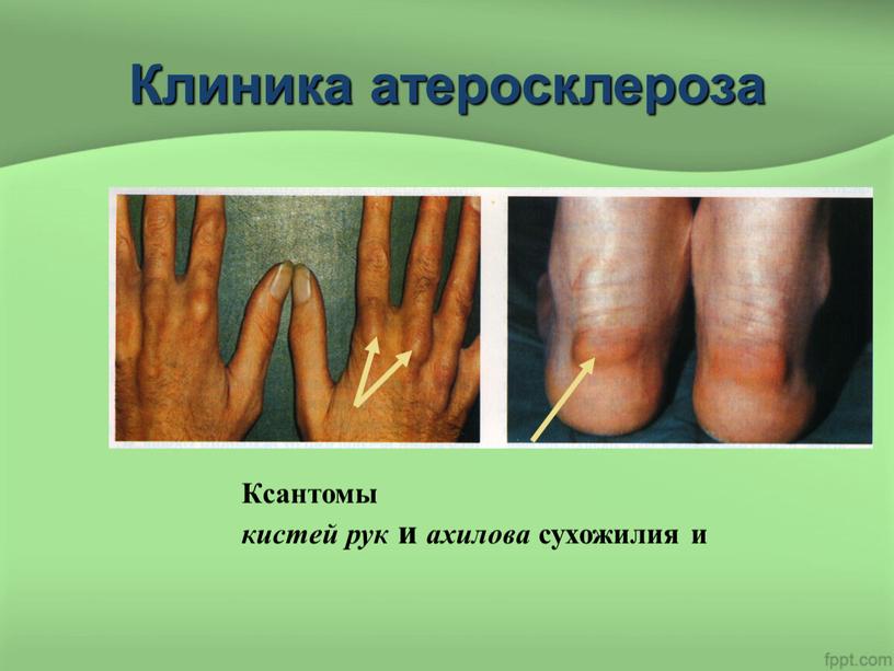 Клиника атеросклероза Ксантомы кистей рук и ахилова сухожилия и
