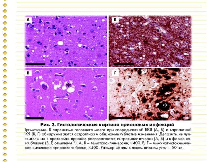 Презентация "Прионная болезнь "