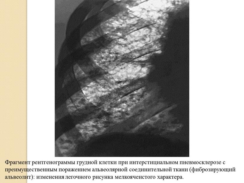 Фрагмент рентгенограммы грудной клетки при интерстициальном пневмосклерозе с преимущественным поражением альвеолярной соединительной ткани (фиброзирующий альвеолит): изменения легочного рисунка мелкоячеистого характера