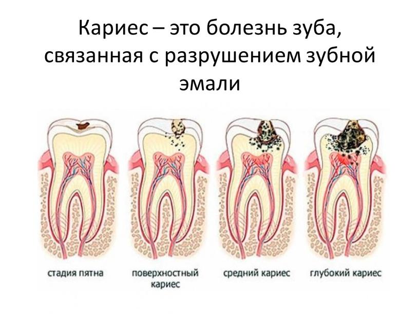 Кариес – это болезнь зуба, связанная с разрушением зубной эмали