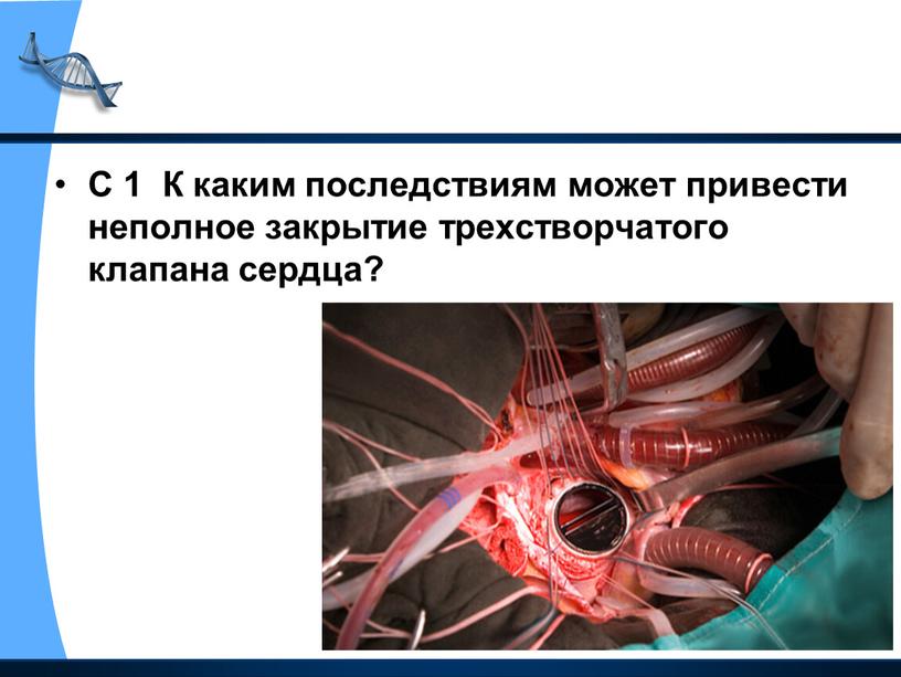 С 1 К каким последствиям может привести неполное закрытие трехстворчатого клапана сердца?