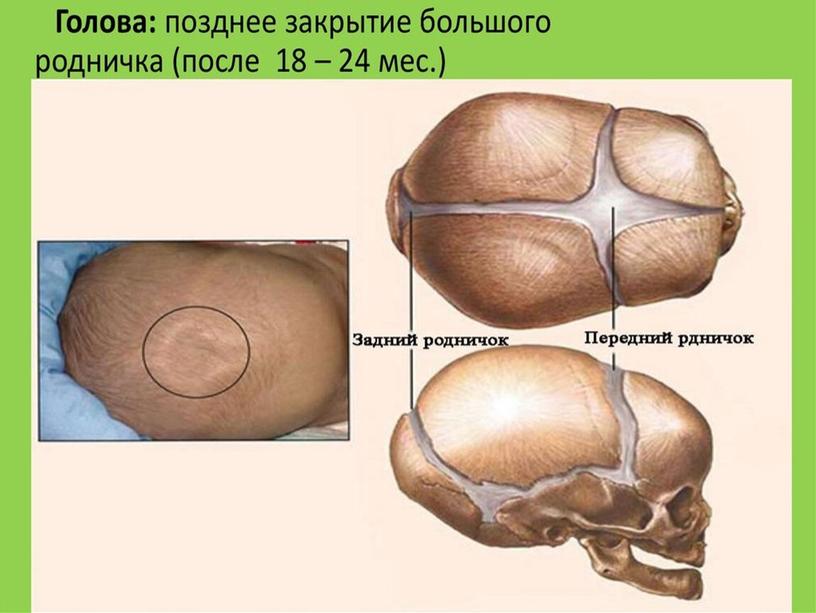 Презентация лекции «Диагностика и лечение рахита, спазмофилии, гипервитаминоза Д»