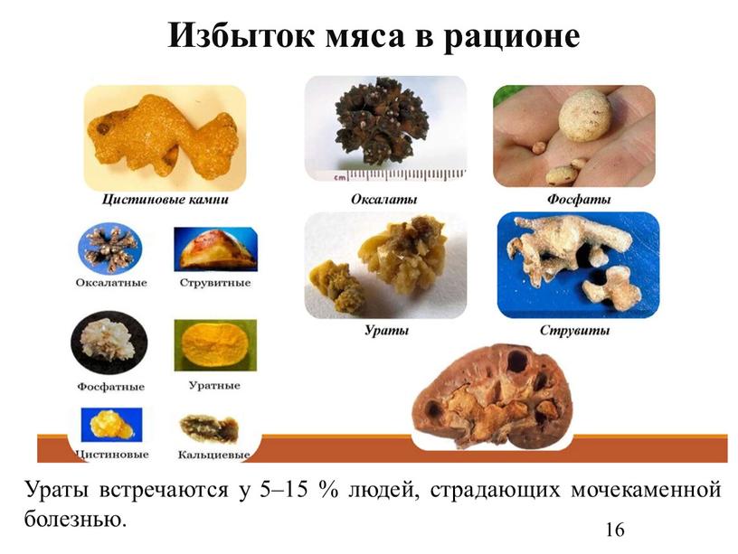 Ураты встречаются у 5–15 % людей, страдающих мочекаменной болезнью