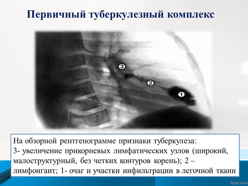 Первичный туберкулезный комплекс