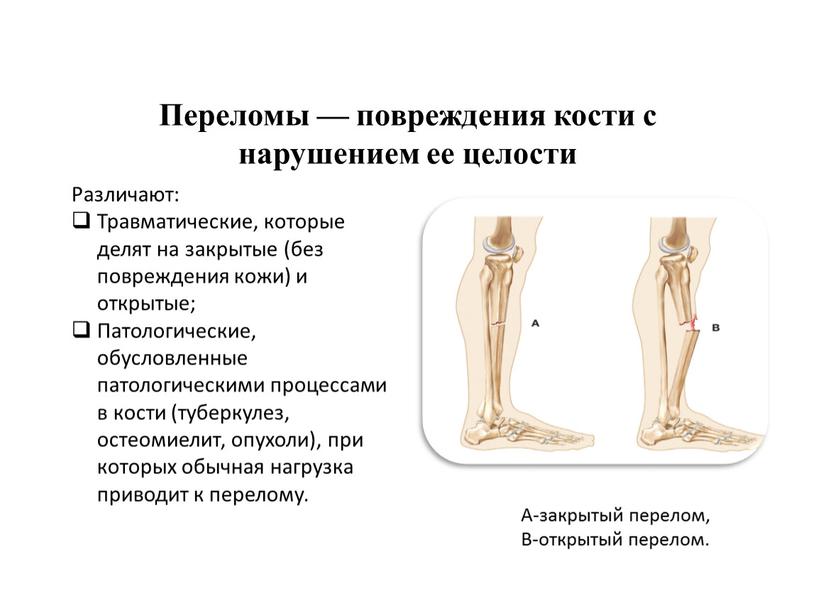 Переломы — повреждения кости с нарушением ее целости