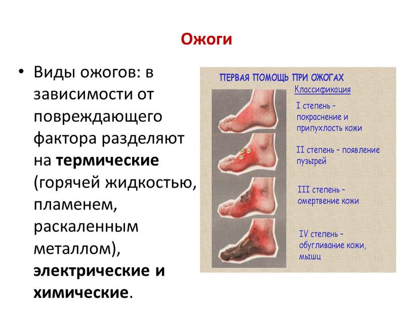 Ожоги Виды ожогов: в зависимости от повреждающего фактора разделяют на термические (горячей жидкостью, пламенем, раскаленным металлом), электрические и химические