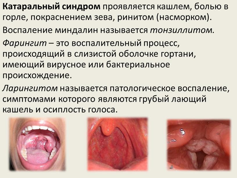 Катаральный синдром проявляется кашлем, болью в горле, покраснением зева, ринитом (насморком)