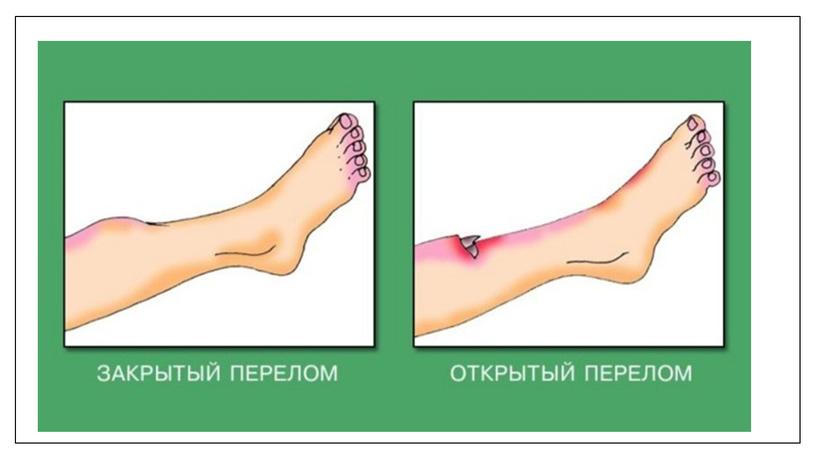 Презентация по ОБЖ на тему Переломы и вывихи