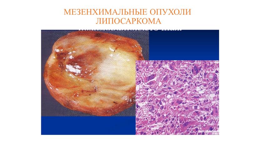 МЕЗЕНХИМАЛЬНЫЕ ОПУХОЛИ ЛИПОСАРКОМА