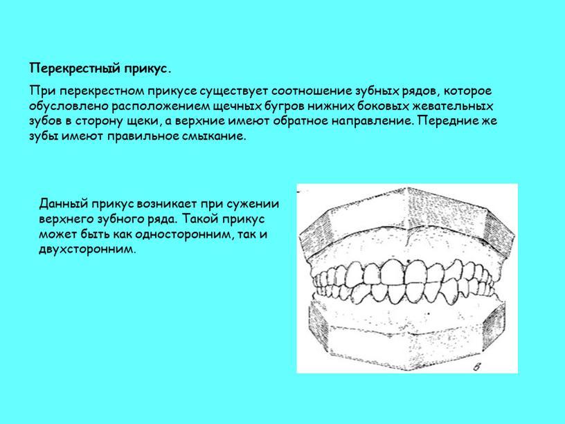 Перекрестный прикус. При перекрестном прикусе существует соотношение зубных рядов, которое обусловлено расположением щечных бугров нижних боковых жевательных зубов в сторону щеки, а верхние имеют обратное…