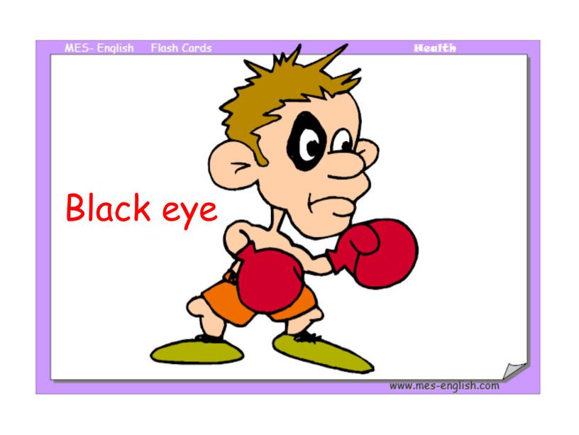 Black eye
