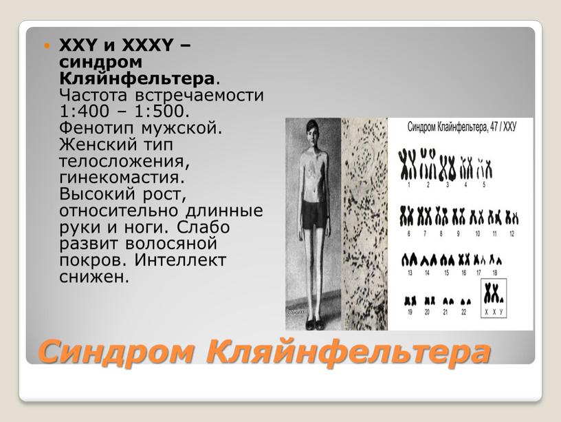 Синдром Кляйнфельтера ХХY и XXXY – синдром