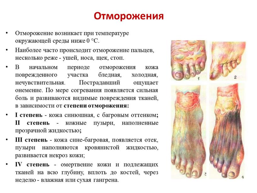 Отморожения Отморожение возникает при температуре окружающей среды ниже 0 °С