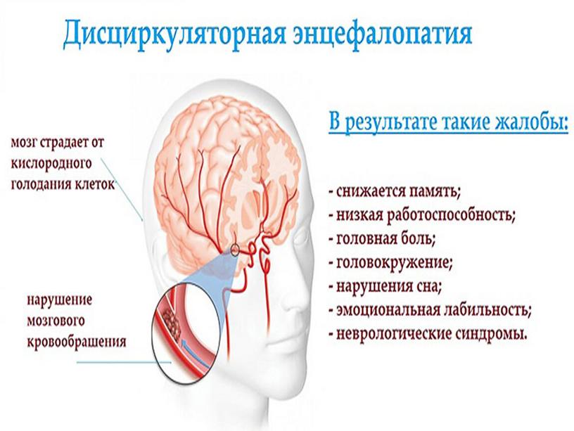 Виды нарушений мозгового кровообращения и их причины