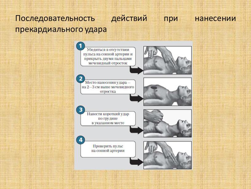 Последовательность действий при нанесении прекардиального удара