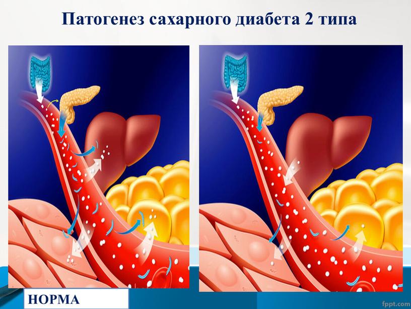 НОРМА Патогенез сахарного диабета 2 типа