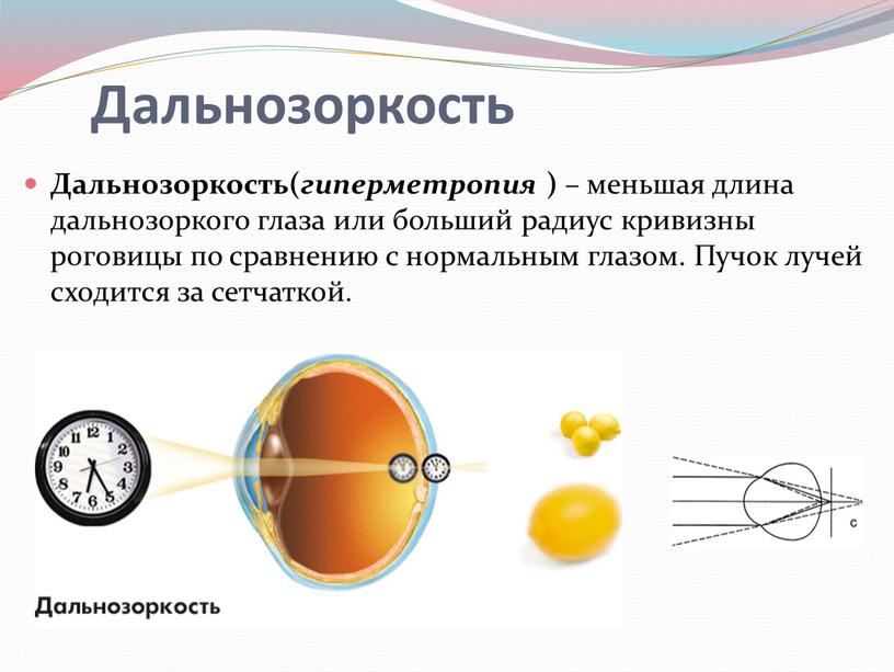 Дальнозоркость( гиперметропия ) – меньшая длина дальнозоркого глаза или больший радиус кривизны роговицы по сравнению с нормальным глазом