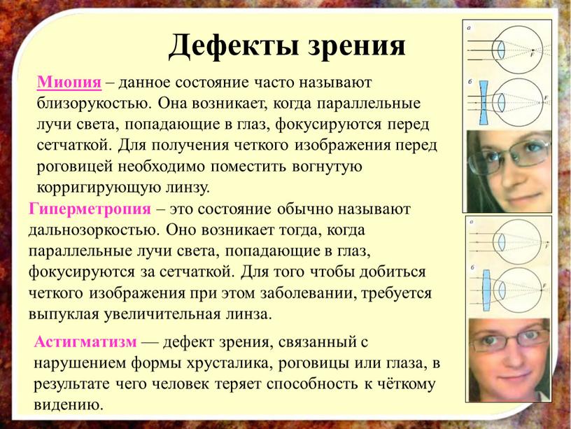 Дефекты зрения Миопия – данное состояние часто называют близорукостью