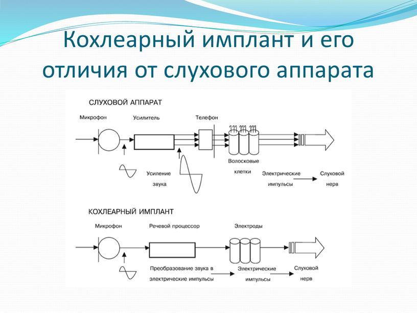 Кохлеарный имплант и его отличия от слухового аппарата