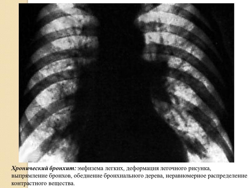 Хронический бронхит: эмфизема легких, деформация легочного рисунка, выпрямление бронхов, обеднение бронхиального дерева, неравномерное распределение контрастного вещества