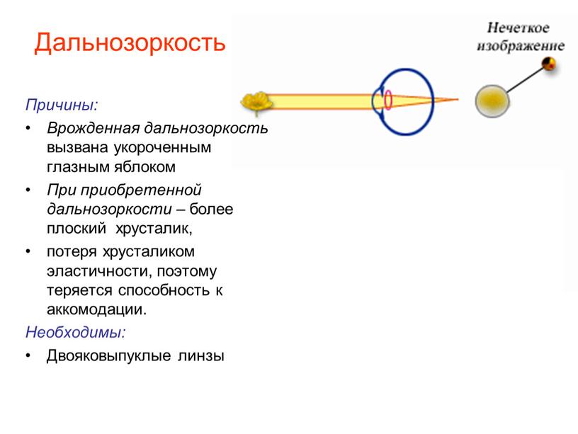 Дальнозоркость Причины: Врожденная дальнозоркость вызвана укороченным глазным яблоком