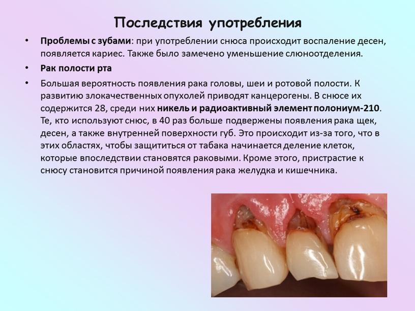 Последствия употребления Проблемы с зубами : при употреблении снюса происходит воспаление десен, появляется кариес