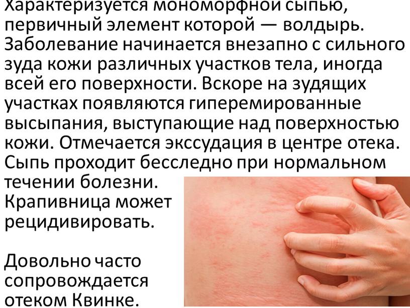 Характеризуется мономорфной сыпью, первичный элемент которой — волдырь