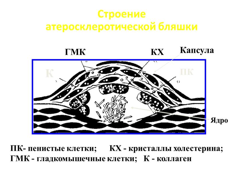 Строение атеросклеротической бляшки