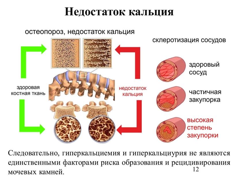 Следовательно, гиперкальциемия и гиперкальциурия не являются единственными факторами риска образования и рецидивирования мочевых камней