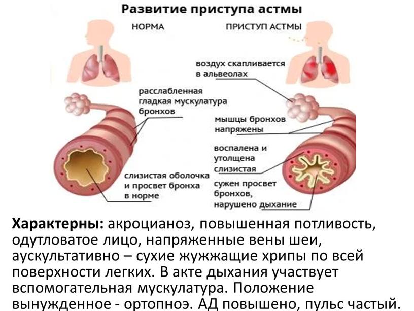 Характерны: акроцианоз, повышенная потливость, одутловатое лицо, напряженные вены шеи, аускультативно – сухие жужжащие хрипы по всей поверхности легких