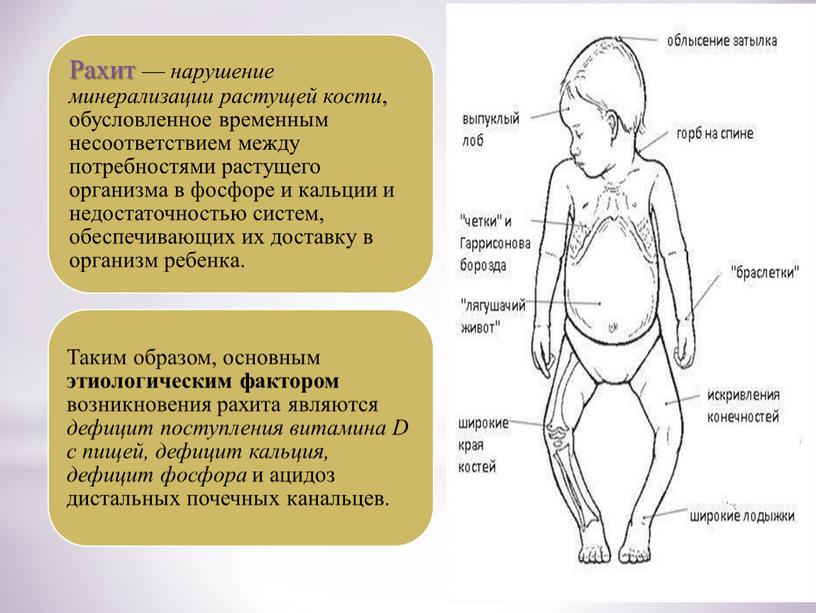 Презентация лекции «Диагностика и лечение рахита, спазмофилии, гипервитаминоза Д»