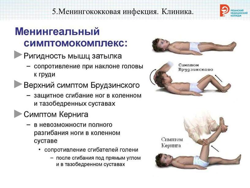 Менингококковая инфекция. Клиника