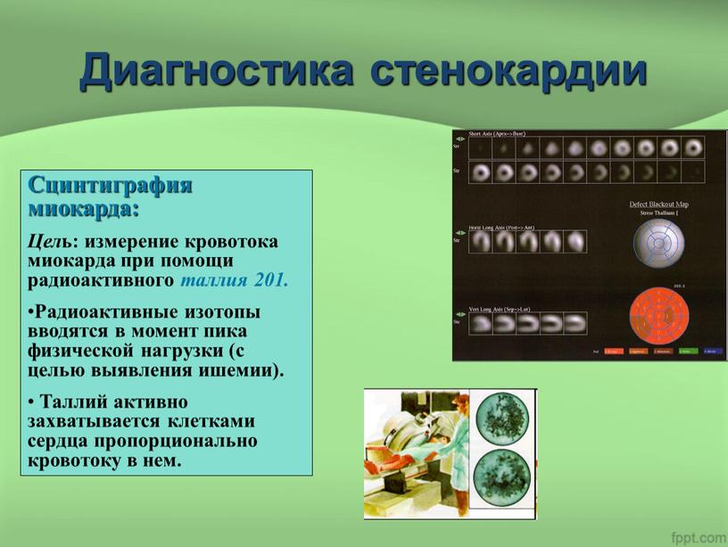 Диагностика стенокардии Сцинтиграфия миокарда: