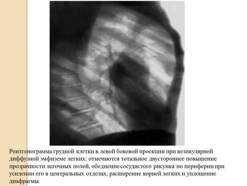 Рентгенограмма грудной клетки в левой боковой проекции при везикулярной диффузной эмфиземе легких: отмечаются тотальное двустороннее повышение прозрачности легочных полей, обеднение сосудистого рисунка по периферии при…
