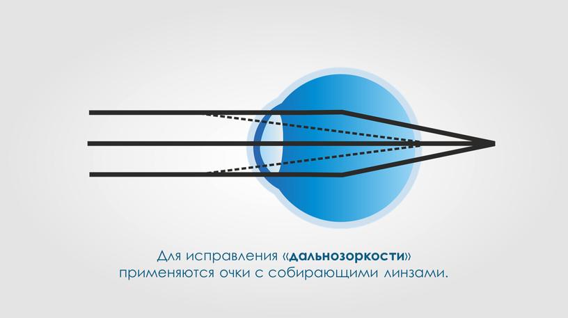 Для исправления « дальнозоркости » применяются очки с собирающими линзами