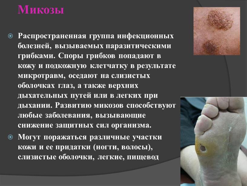 Микозы Распространенная группа инфекционных болезней, вызываемых паразитическими грибками