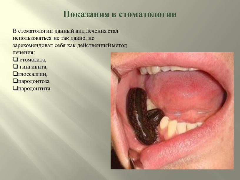 Показания в стоматологии В стоматологии данный вид лечения стал использоваться не так давно, но зарекомендовал себя как действенный метод лечения: стоматита, гингивита, глоссалгии, пародонтоза пародонтита