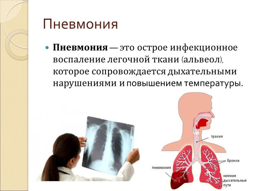 Пневмония Пневмония — это острое инфекционное воспаление легочной ткани (альвеол), которое сопровождается дыхательными нарушениями и повышением температуры