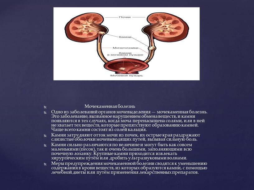 Мочекаменная болезнь Одно из заболеваний органов мочевыделения — мочекаменная болезнь