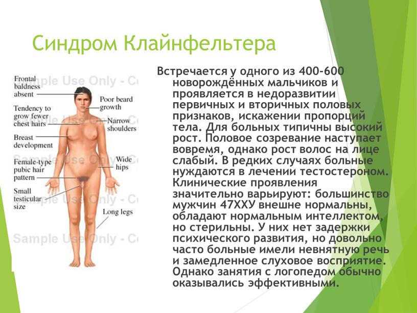 Синдром Клайнфельтера Встречается у одного из 400-600 новорождённых мальчиков и проявляется в недоразвитии первичных и вторичных половых признаков, искажении пропорций тела