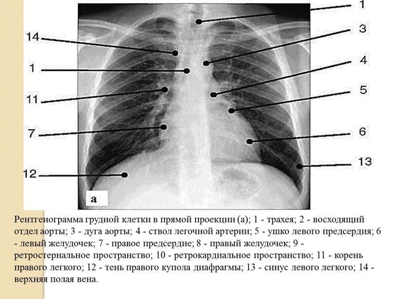 Рентгенограмма грудной клетки в прямой проекции (а); 1 - трахея; 2 - восходящий отдел аорты; 3 - дуга аорты; 4 - ствол легочной артерии; 5…