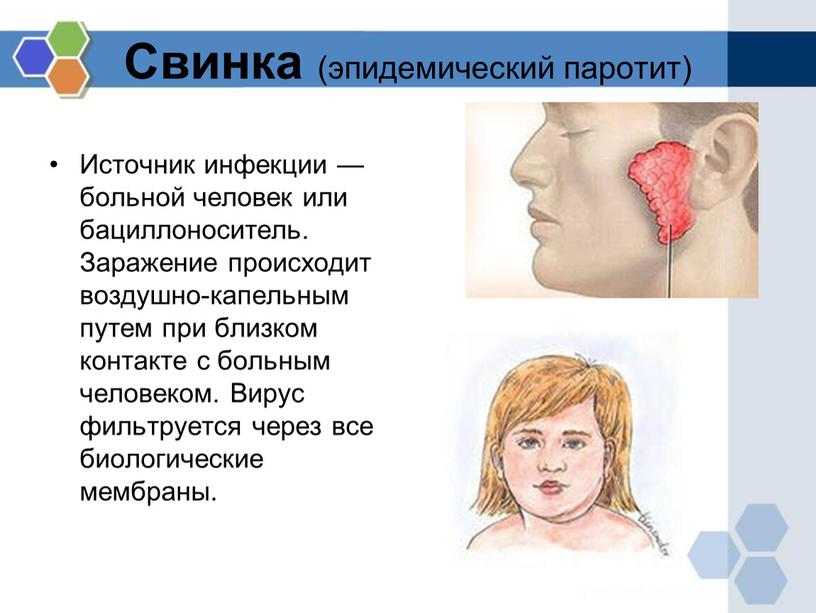 Свинка (эпидемический паротит)