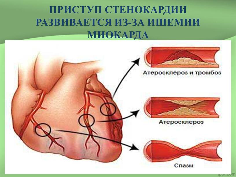 ПРИСТУП СТЕНОКАРДИИ РАЗВИВАЕТСЯ