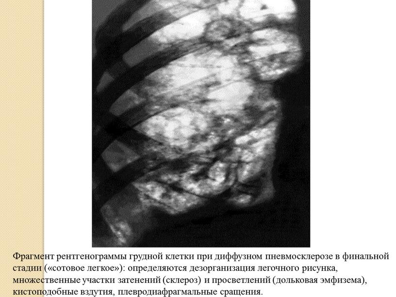 Фрагмент рентгенограммы грудной клетки при диффузном пневмосклерозе в финальной стадии («сотовое легкое»): определяются дезорганизация легочного рисунка, множественные участки затенений (склероз) и просветлений (дольковая эмфизема), кистоподобные…