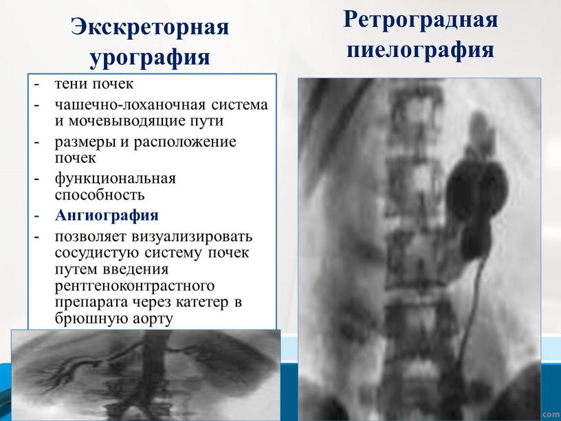 Экскреторная урография тени почек чашечно-лоханочная система и мочевыводящие пути размеры и расположение почек функциональная способность